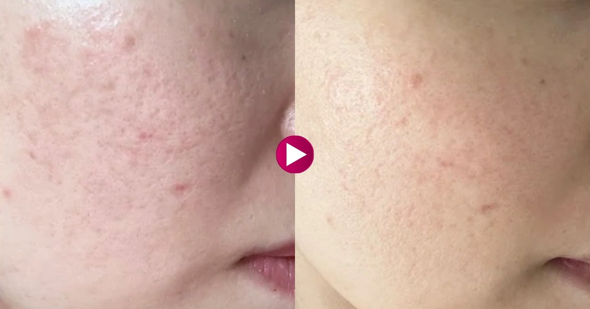 Làm mờ sẹo lõm