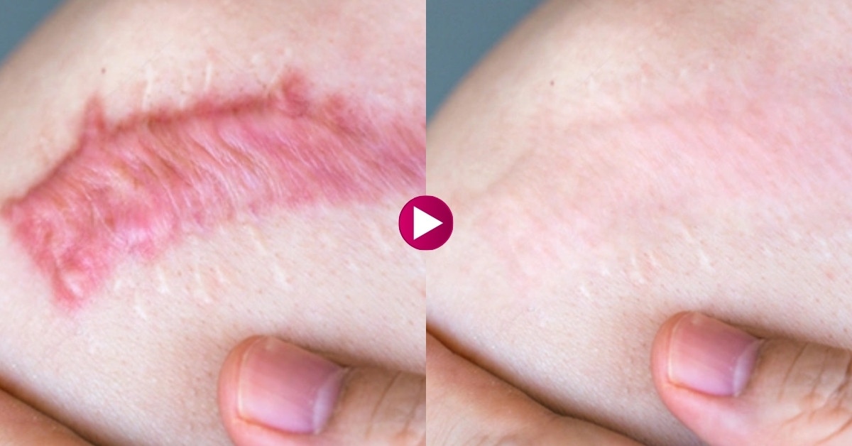 Làm mờ sợi co kéo, sẹo phì đại