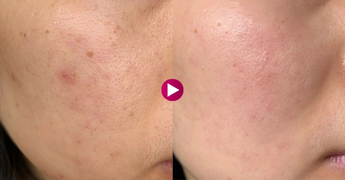 Làn da săn chắc và đàn hồi hơn