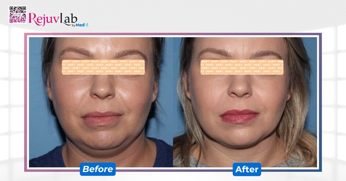 Hiệu quả của laser hủy mỡ cằm vào 7 tuần sau 1 buổi điều trị