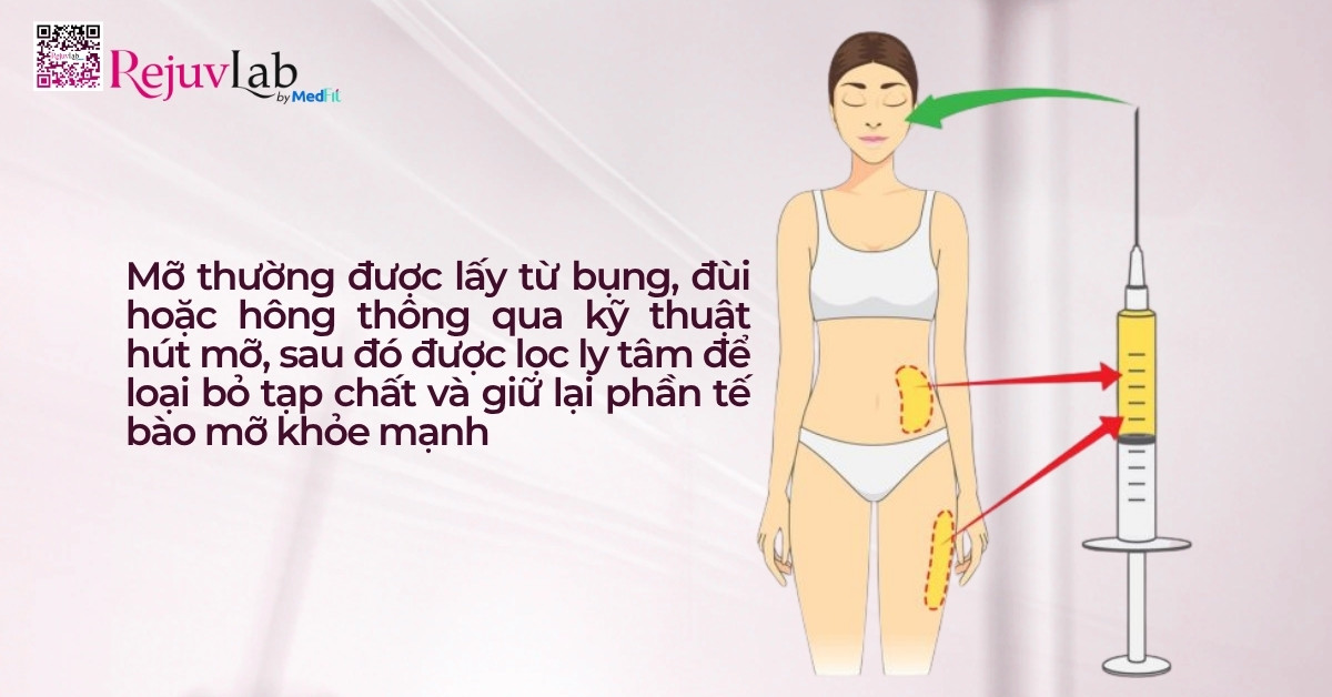 Mỡ thường được lấy từ bụng, đùi hoặc hông thông qua kỹ thuật hút mỡ, sau đó được lọc ly tâm để loại bỏ tạp chất và giữ lại phần tế bào mỡ