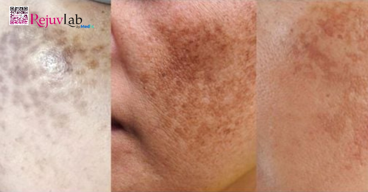 Người bị nám mảng, nám hỗn hợp hoặc sạm da do rối loạn sắc tố là đối tượng phù hợp tiêm meso trị nám