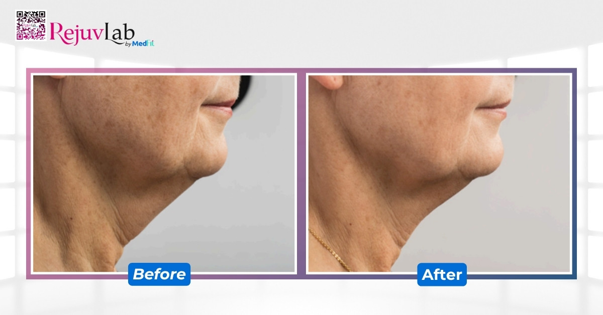 Hiệu quả của quang đông hủy mỡ cằm vào 12 tuần sau 2 buổi điều trị