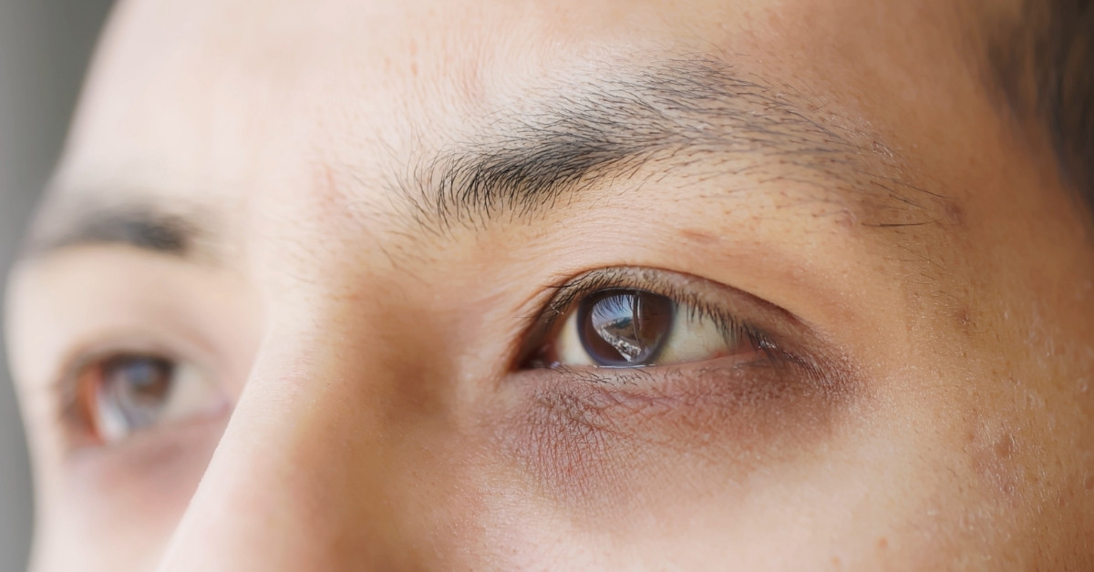 Quầng thâm vùng da quanh mắt