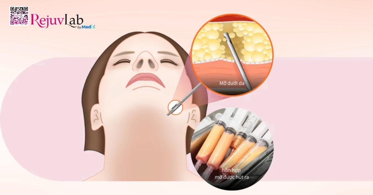 Rạch một đường nhỏ dưới cằm (khoảng 0,2cm) để đưa ống hút vào, phá vỡ lớp mỡ và hút mỡ thừa ra ngoài, đồng thời có thể kết hợp làm săn da