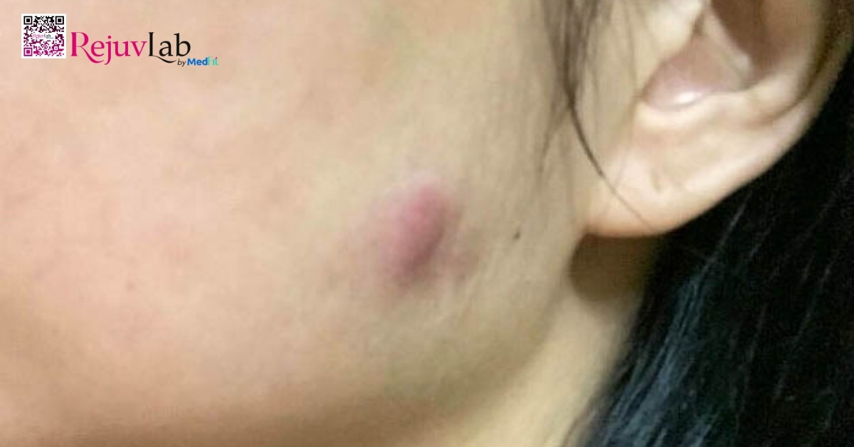 Tiêm Botox gọn hàm giá bao nhiêu? Review hiệu quả thực tế tại RejuvLab 4 Sưng, bầm, đau nhẹ tại vị trí tiêm do kim tác động vào mạch máu nhỏ dưới da