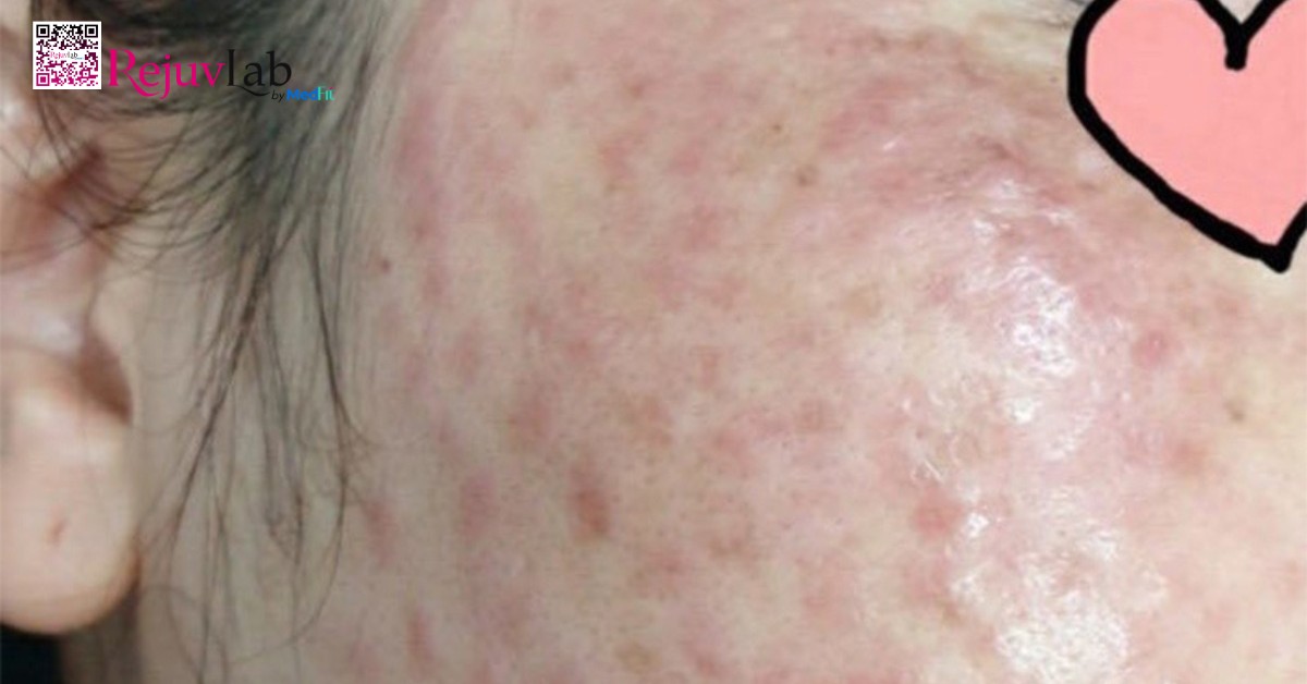 Tac dung phu tiem meoso