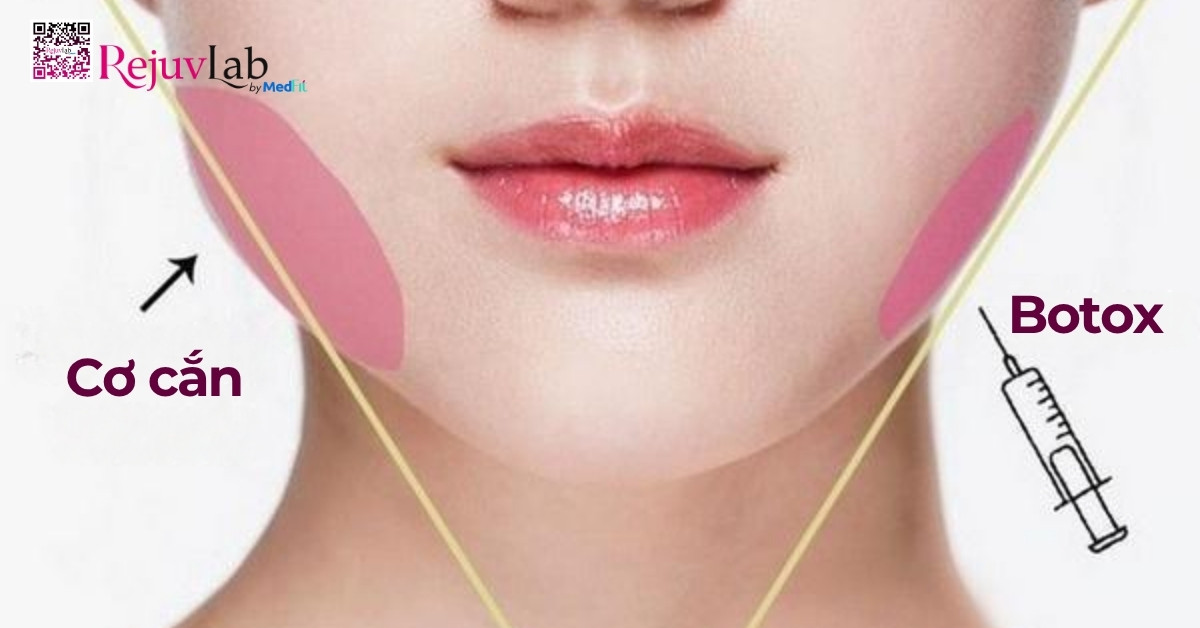 Tiêm Botox gọn hàm giá bao nhiêu? Review hiệu quả thực tế tại RejuvLab 1 Tiem botox co can