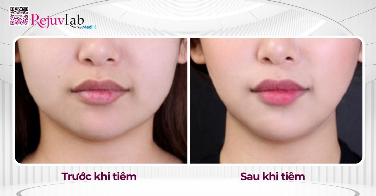 Tiêm Botox gọn hàm giá bao nhiêu? Review hiệu quả thực tế tại RejuvLab 8 Gương mặt trở nên thon gọn và hài hòa hơn chỉ sau vài tuần tiêm Botox gọn hàm