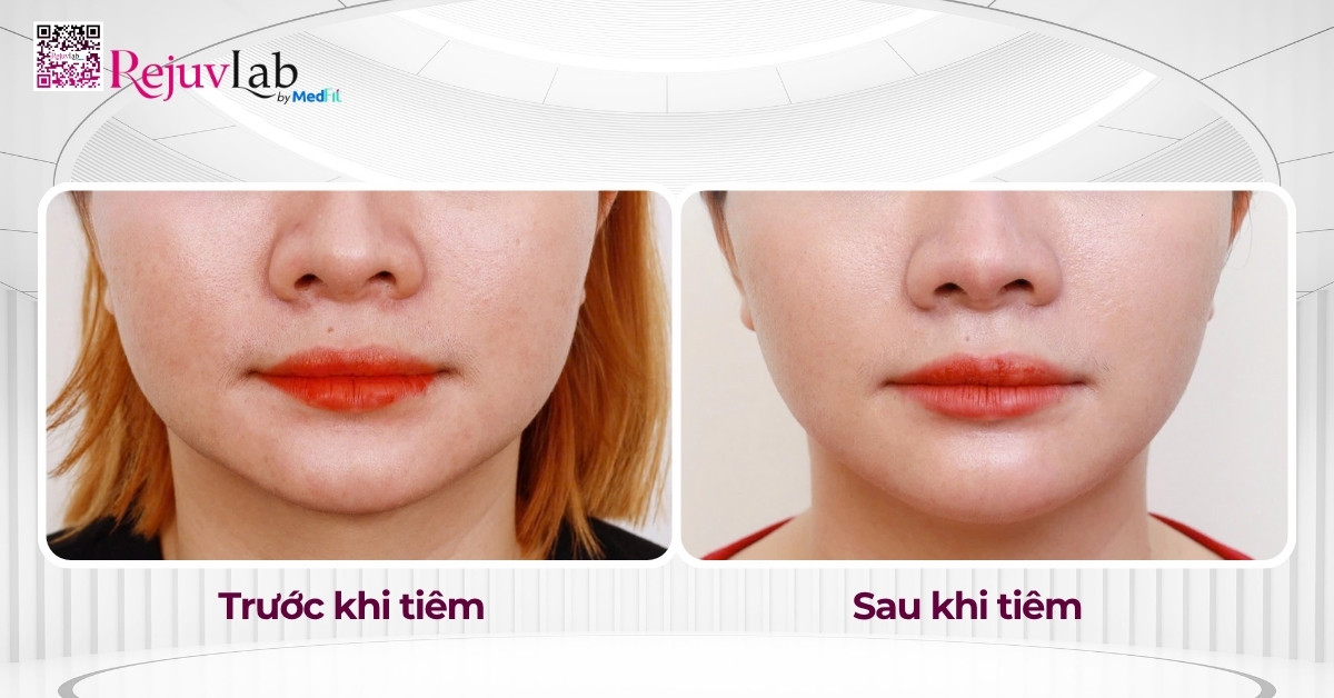 Top phương pháp tiêm thon gọn mặt, giúp sở hữu gương mặt V-line 5 Tiem botox co ham