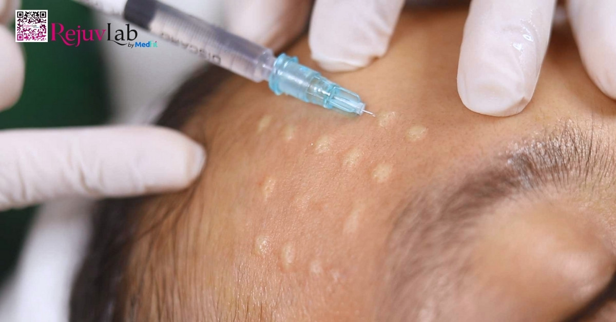 Tiêm căng bóng da, còn gọi là tiêm vi điểm hyaluronic acid (HA) hoặc tiêm meso HA, là phương pháp thẩm mỹ nội khoa giúp cải thiện rõ rệt độ ẩm và độ đàn hồi của da