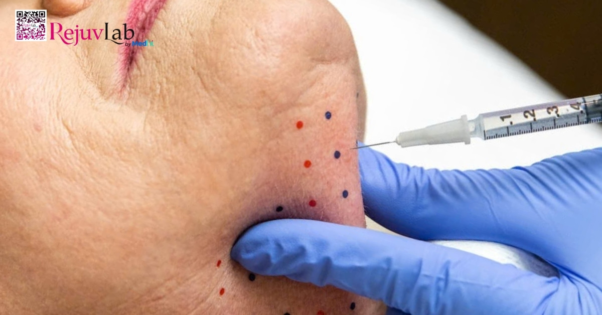 Tiêm tan mỡ chỉ xâm lấn tối thiểu, phù hợp cho những vùng mỡ nhỏ như nọng cằm và mang lại kết quả rõ rệt sau vài tuần khi được thực hiện đúng kỹ thuật bởi Bác sĩ chuyên khoa