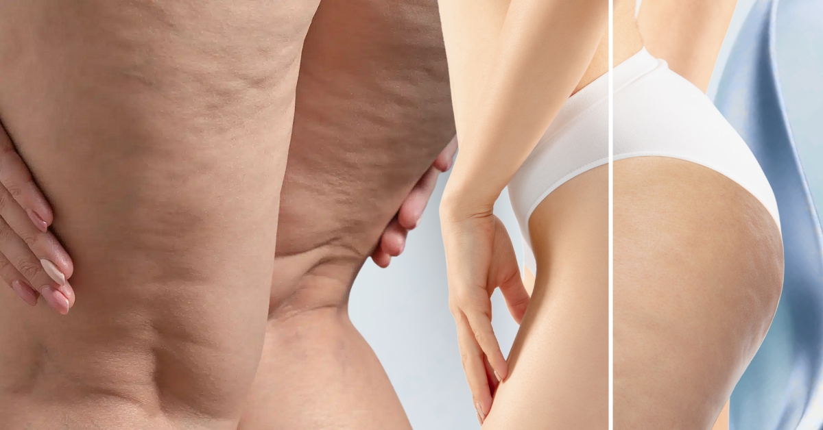 Xuất hiện phổ biến ở phục nữ Xuất hiện phổ biến ở phục nữ