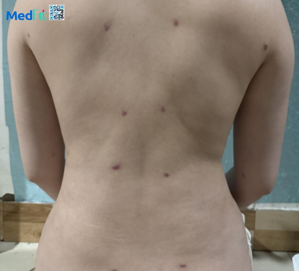 bề mặt da không đều sau khi hút mỡ lưng