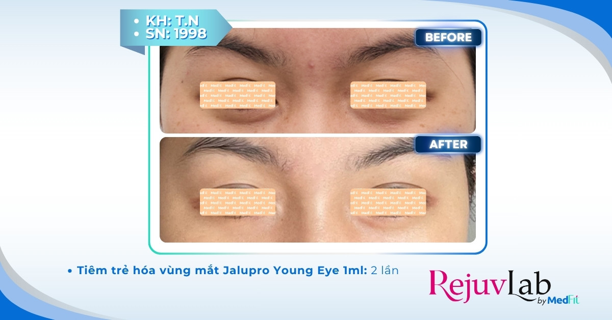 ca lâm sàng trẻ hóa vùng mắt tại rejuvlab