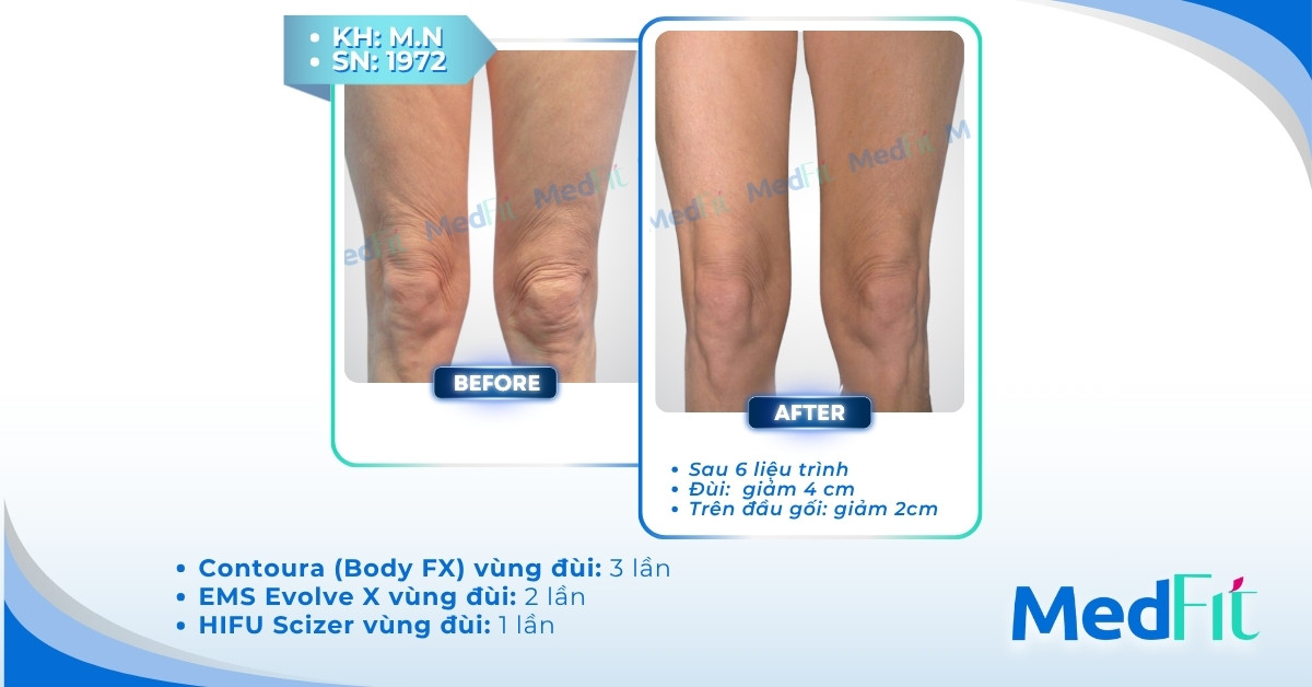 cls giảm mỡ đùi tại medfit