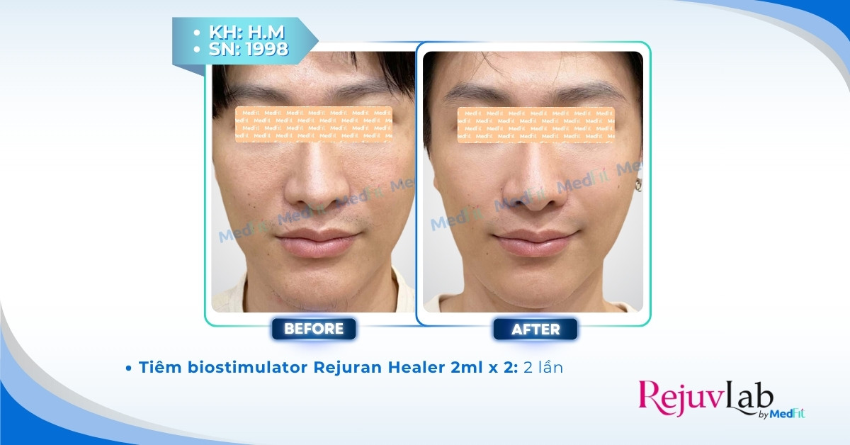 Hướng dẫn chăm sóc da sau tiêm meso để da căng bóng, mịn màng 4 cls tiêm meso rejuran healer