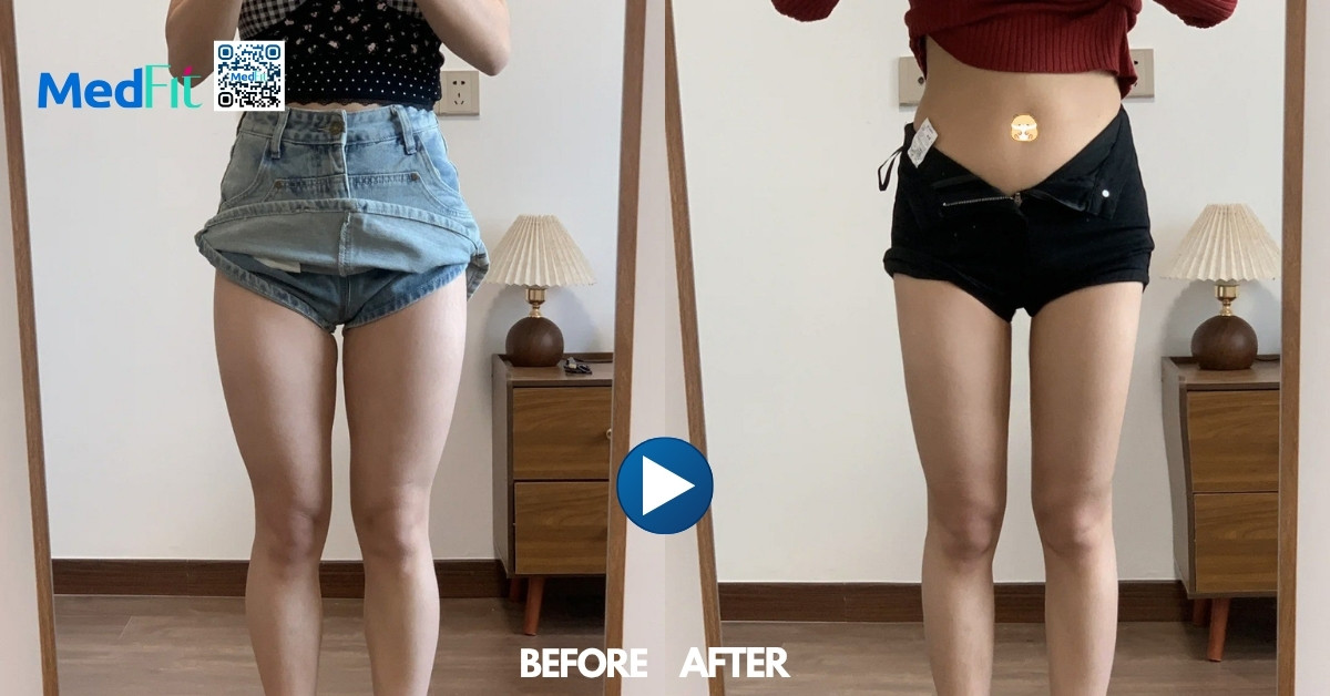 hiệu quả của hút mỡ đùi