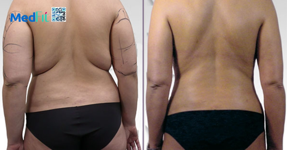 hiệu quả hút mỡ lưng