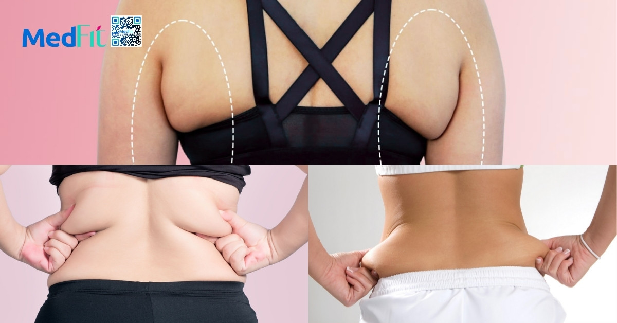 hình minh họa 3 nhóm mỡ lưng