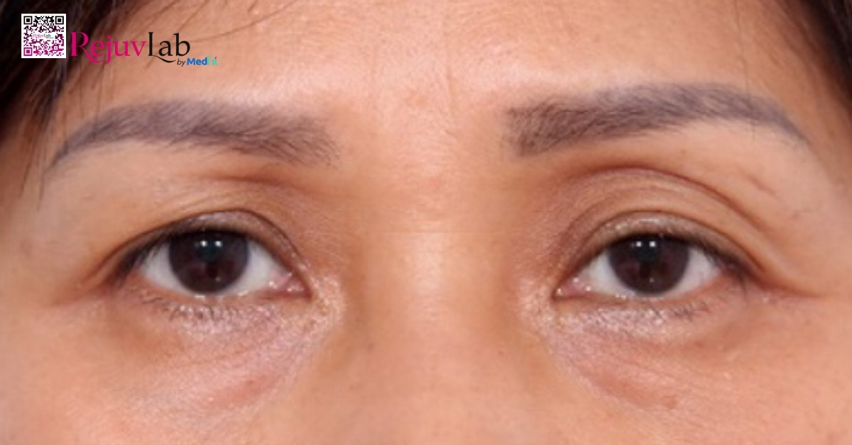 hình minh họa hốc mắt trũng sâu