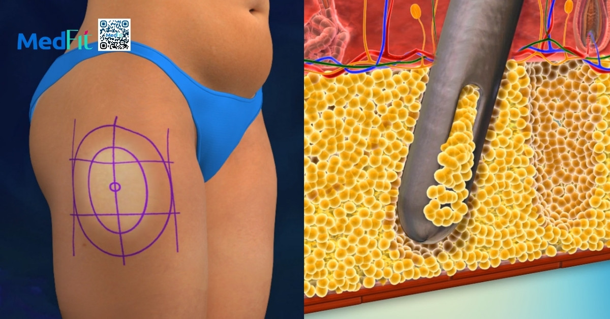 hình minh họa hút mỡ đùi