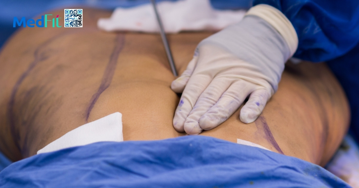 hình minh họa hút mỡ lưng