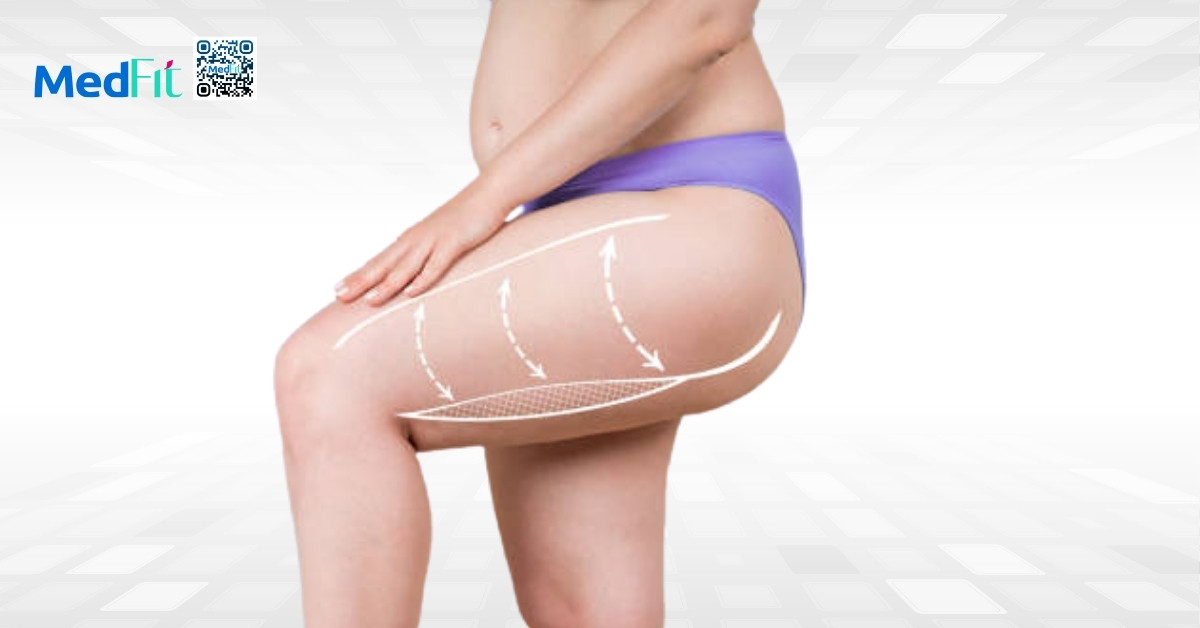 hình minh họa người có mỡ đùi