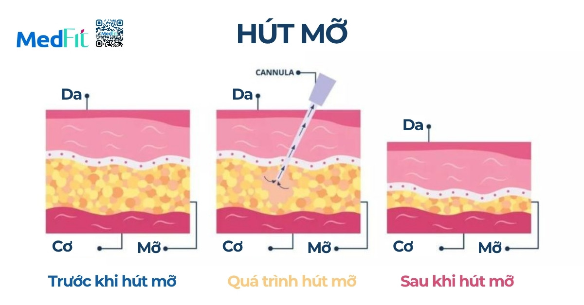 hình minh họa quá trình hút mỡ