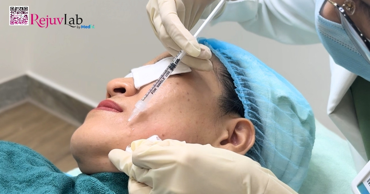 hình minh họa tiêm meso