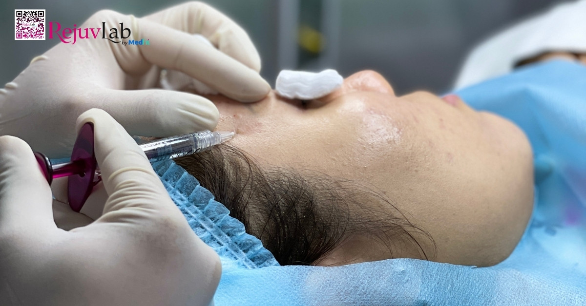 tiêm meso hình minh họa