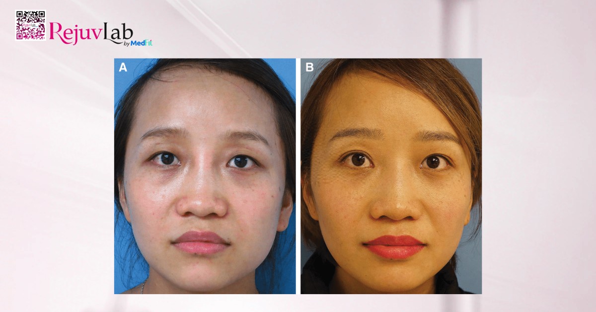 trước và sau khi cấy mỡ mắt sâu