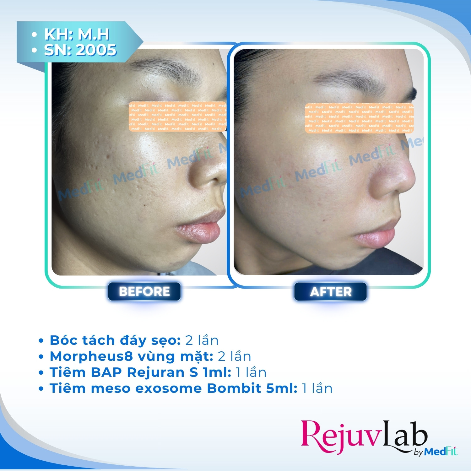 Trị sẹo rỗ 2