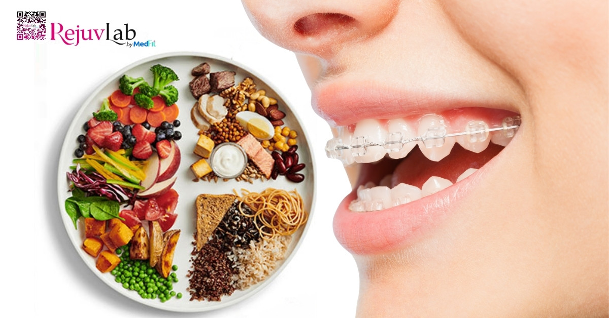 Giải đáp: Niềng răng có giúp mặt thon gọn không? 7 Che do an uong khi nieng rang