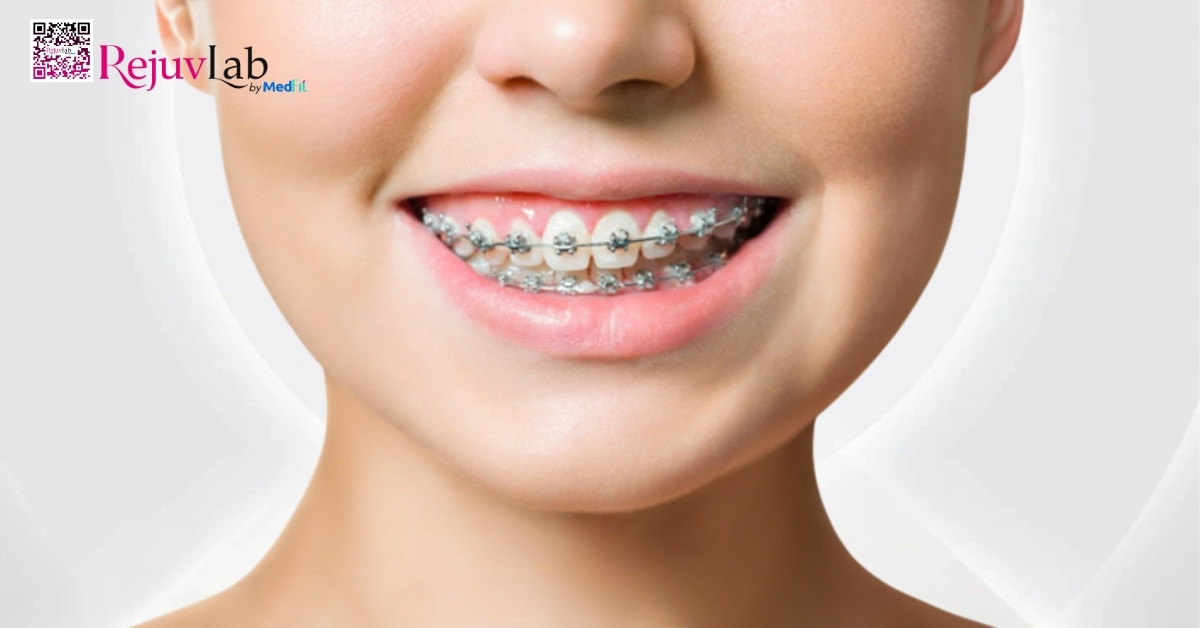 Giải đáp: Niềng răng có giúp mặt thon gọn không? 9 Co mat san chac