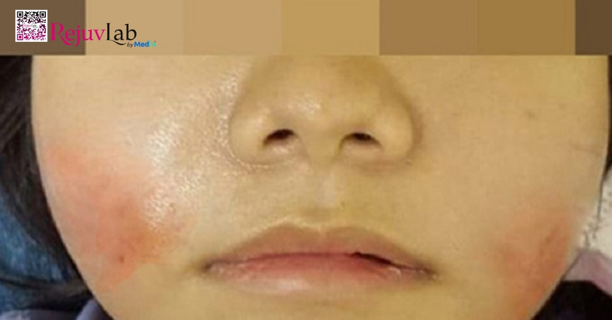 Da loi lom khong deu