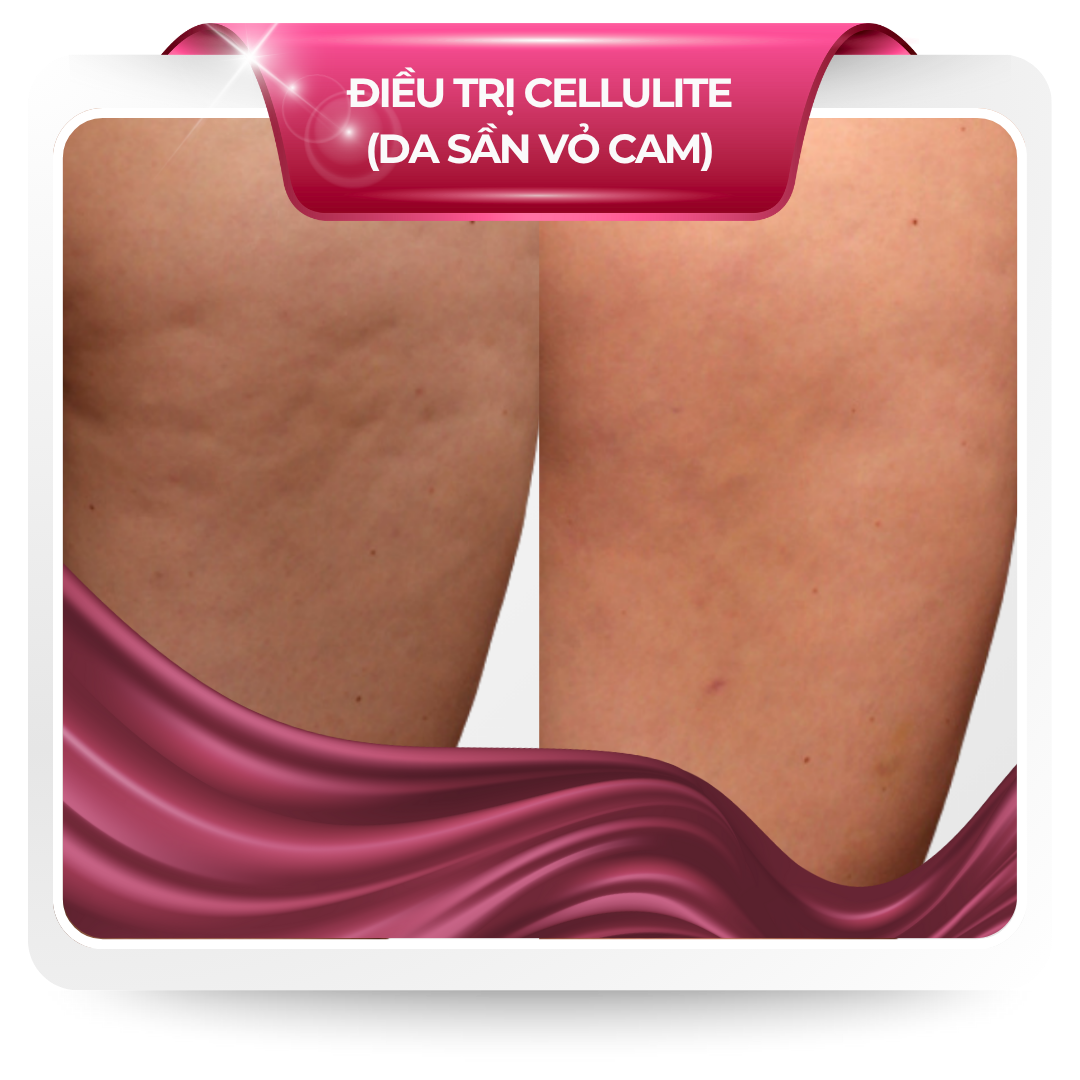 Điều trị Cellulite (da sần vỏ cam)