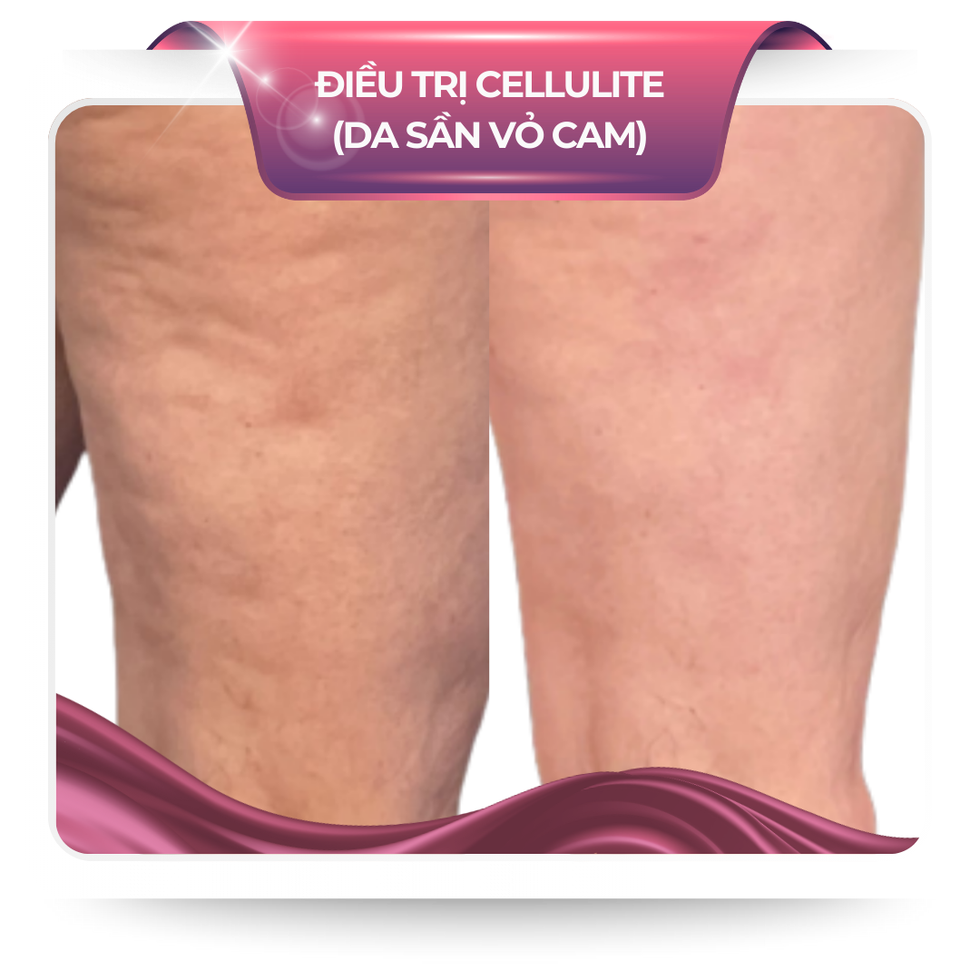Điều trị cellutide