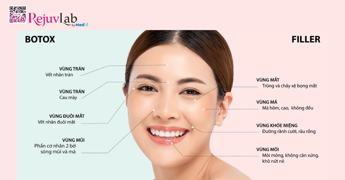 Khi nào tiêm filler, khi nào tiêm botox? 11 Filler va