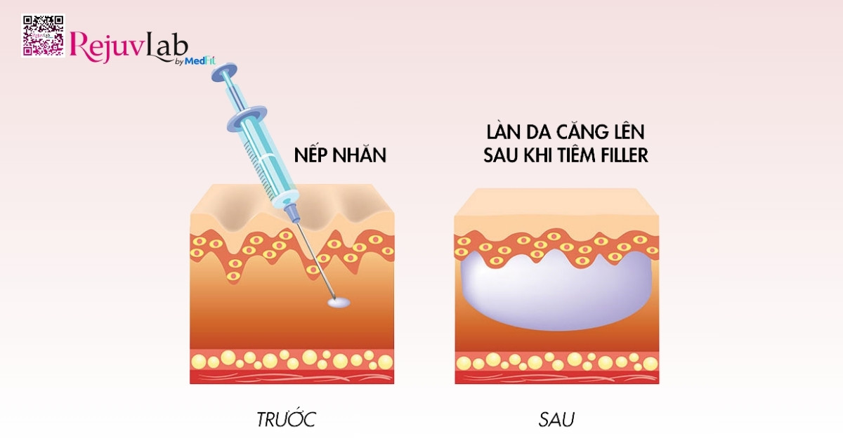 Tiêm filler bao lâu thì tan và khi nào nên tiêm lại? 1 Filler