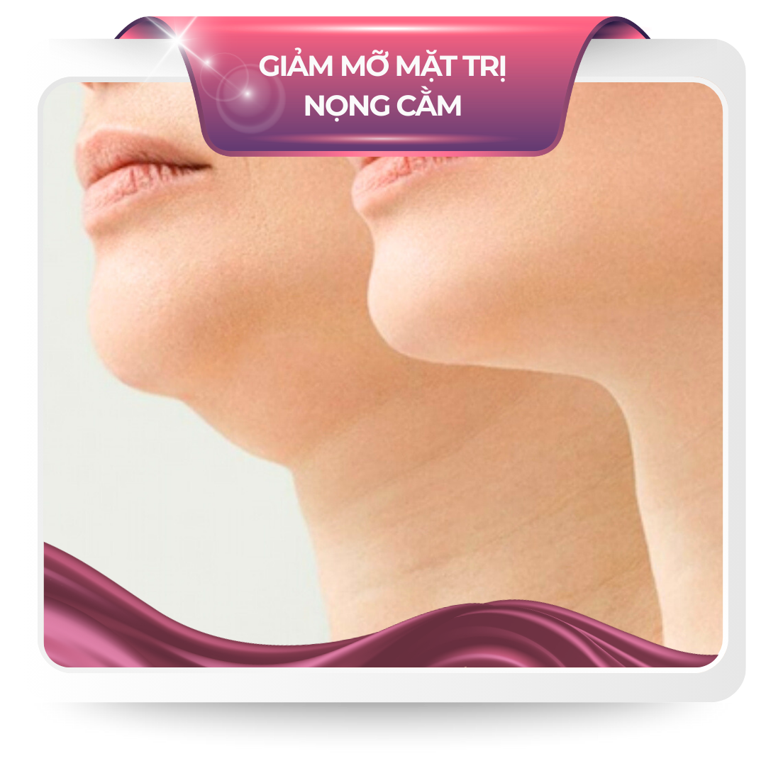 Giảm mỡ mặt trị nọng cằm