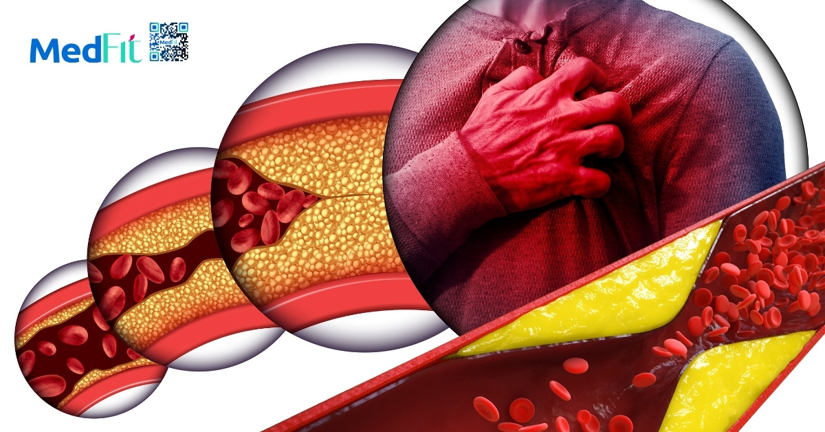 Cách uống bột đậu đỏ giảm cân an toàn và dễ áp dụng mỗi ngày 3 Bột đậu đỏ góp phần giảm nguy cơ xơ vữa động mạch và các bệnh lý tim mạch