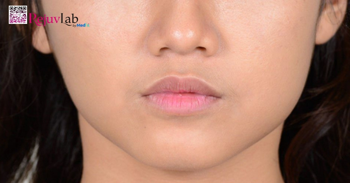 Nếu liều Botox quá thấp hoặc tiêm sai vị trí, hiệu quả thon gọn mặt sẽ kém hoặc không đồng đều giữa hai bên