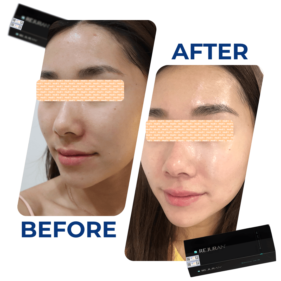 Hiệu quả tiêm Rejuran Healer
