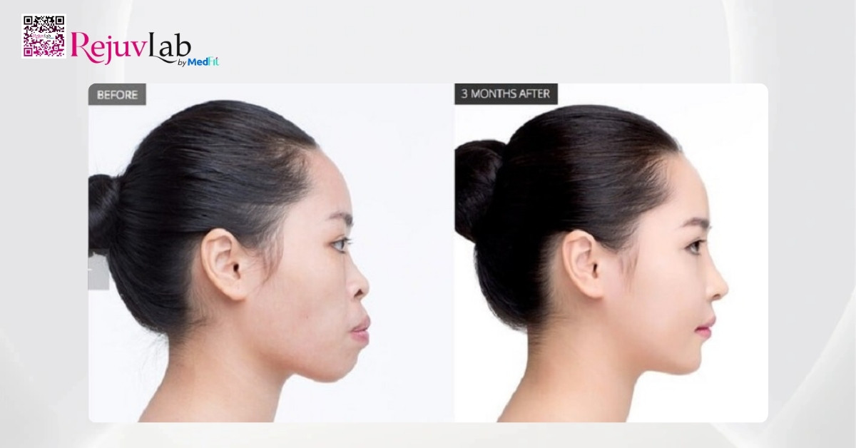 Giải đáp: Niềng răng có giúp mặt thon gọn không? 2 Khop can nho