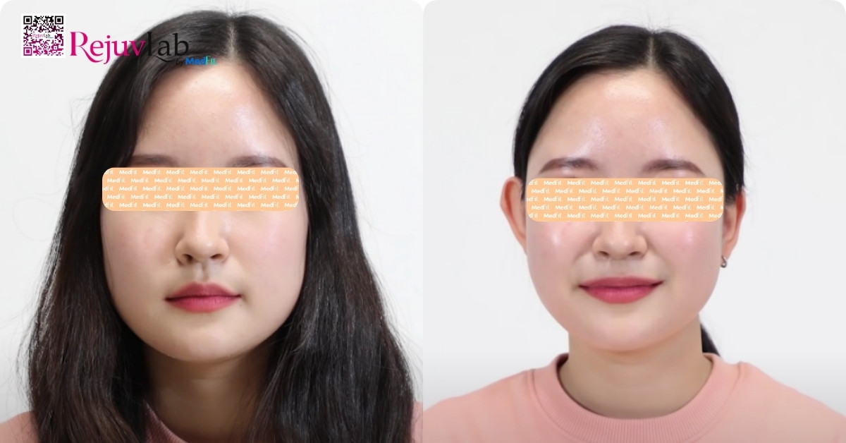 4 phương pháp thẩm mỹ làm gương mặt thon gọn, cân đối 1 Hình minh họa khuôn mặt vuông to (bên trái) và gương mặt thon gọn (bên phải)