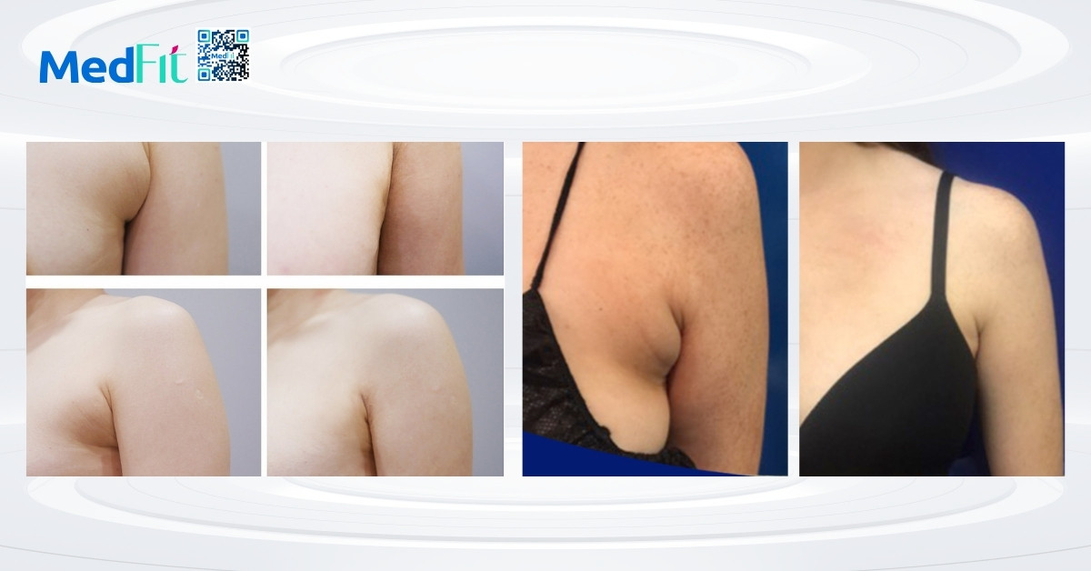 Loai bo mo vung nach