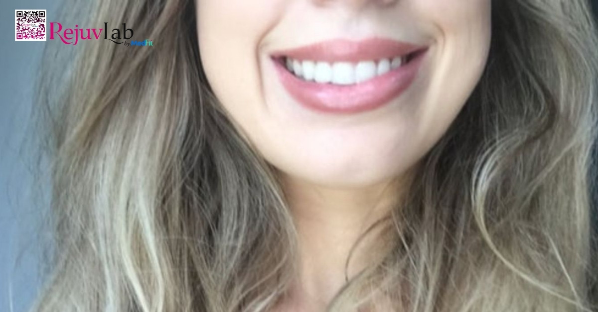 Khi Botox lan ra ngoài vùng cơ cắn, có thể gây mất cân xứng nụ cười