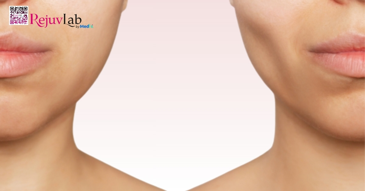 Khi nào tiêm filler, khi nào tiêm botox? 9 Mat mat the tich