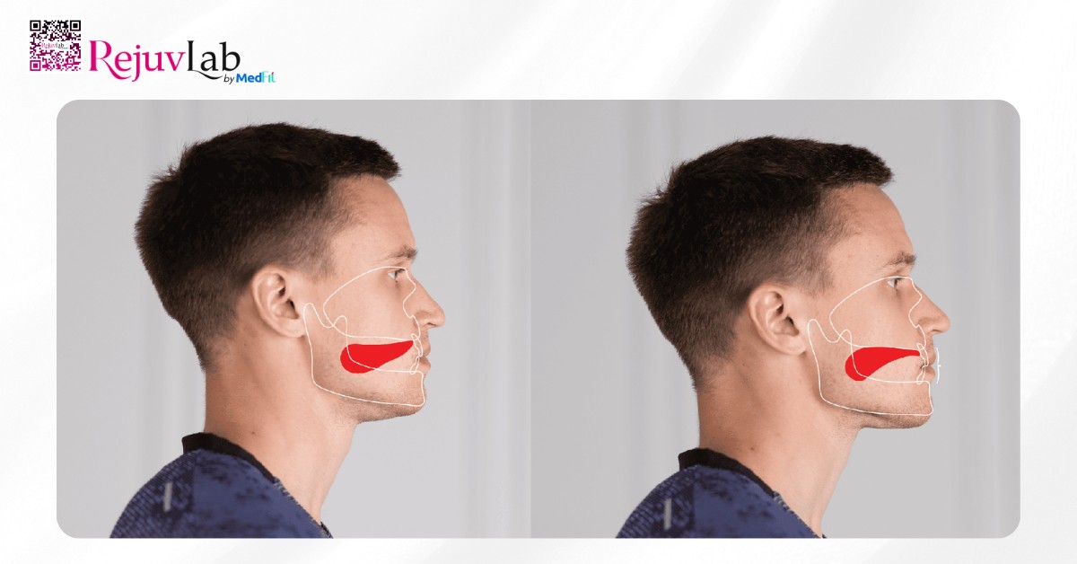 Bài tập thon gọn mặt tại nhà: 10 phút mỗi ngày là đủ 8 Mewing